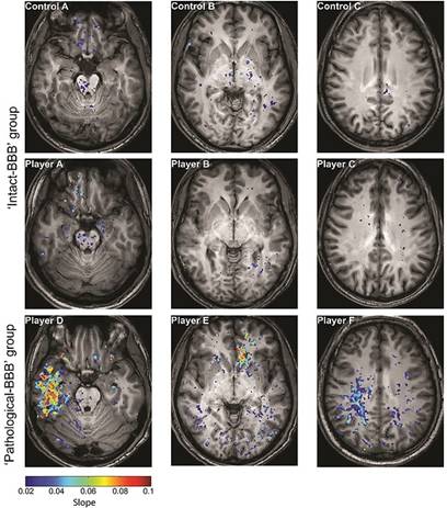 Fotos de escaneos cerebrales de jugadores de fútbol